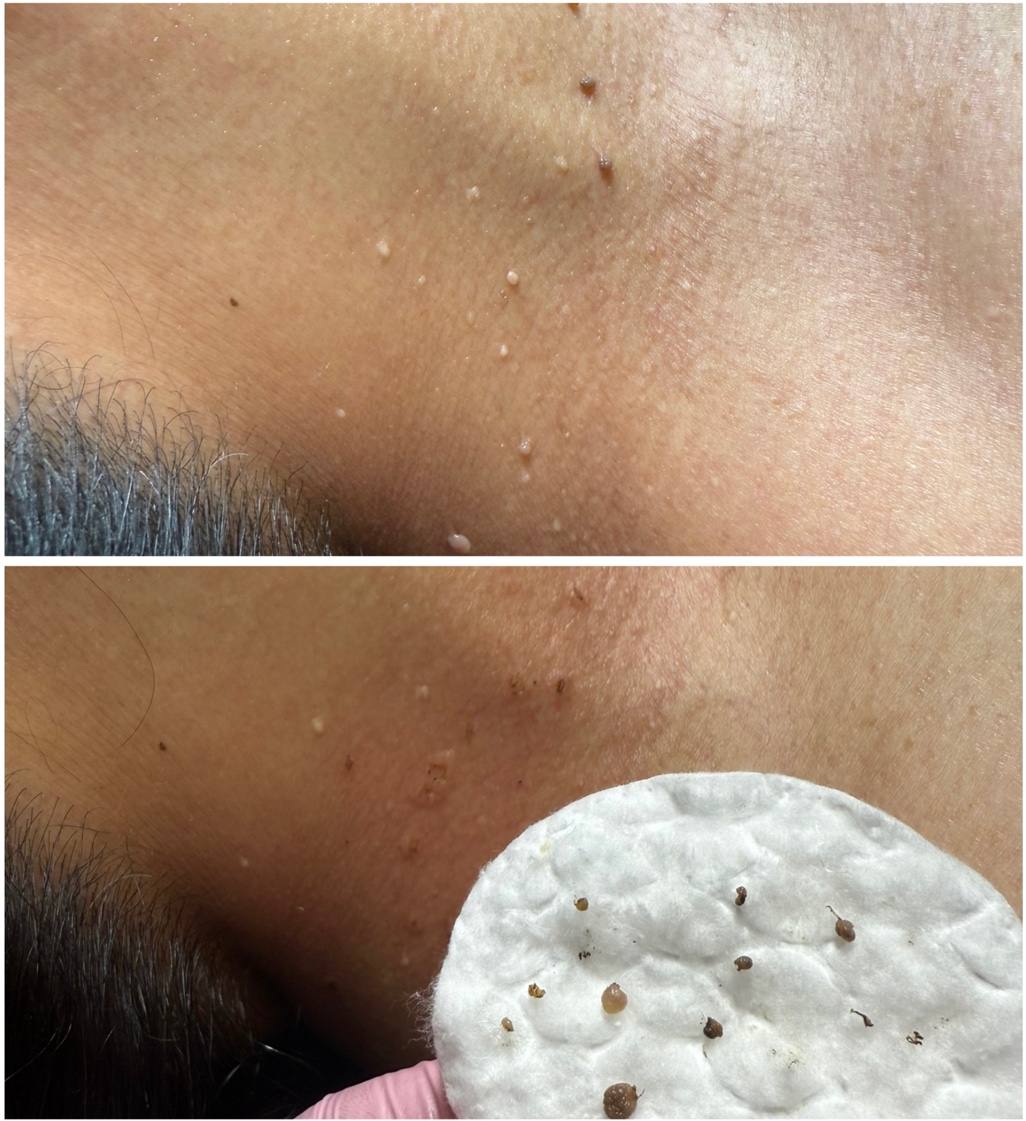 Skin treatment extraction results Point Loma esthetician